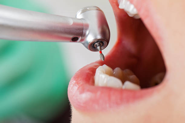 Best Emergency Tooth Extraction in Combe, LA